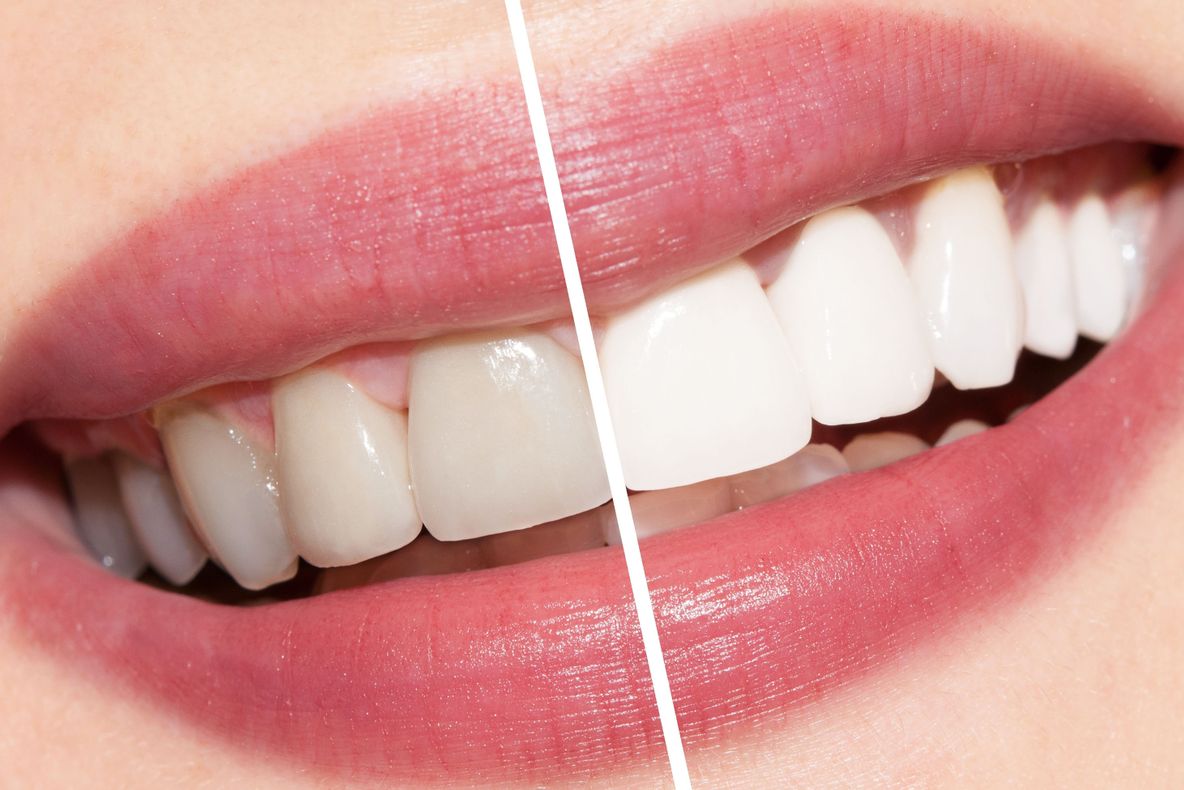 Cea mai simplă metodă de albire a dinţilor, cu un ingredient ieftin pe care îl ai în casă