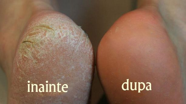 Cum să-ţi cureţi călcâiele cu bicarbonat de sodiu