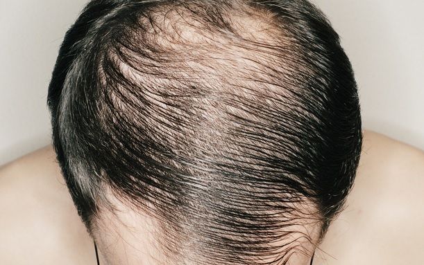 Ce boli cumplite poate ascunde chelia 