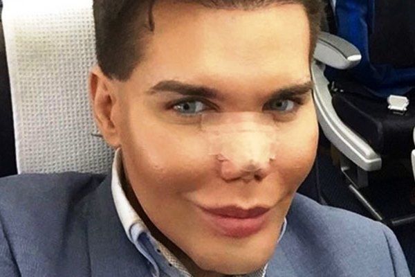 Dezastru pentru bărbatul are a făcut 42 de operaţii estetice. Cum arată acum