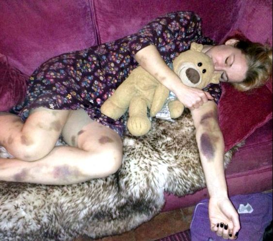 S-a trezit plină de vânătăi, după o noapte în oraș. Când a aflat cauza a înghețat de frică