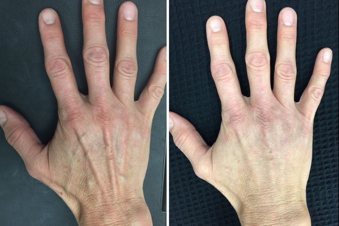 Unguentul minune pentru mâini care elimină ridurile și petele de vârstă