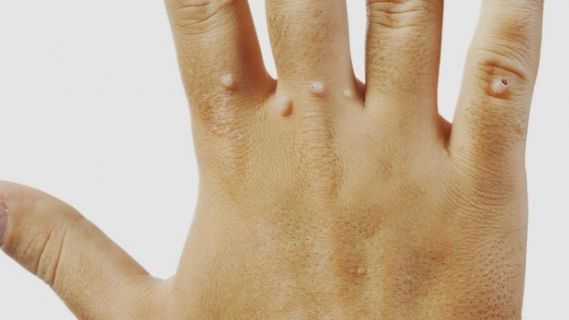 Adevărul despre negi. De ce apar şi care este, de fapt, legătura cu broaştele