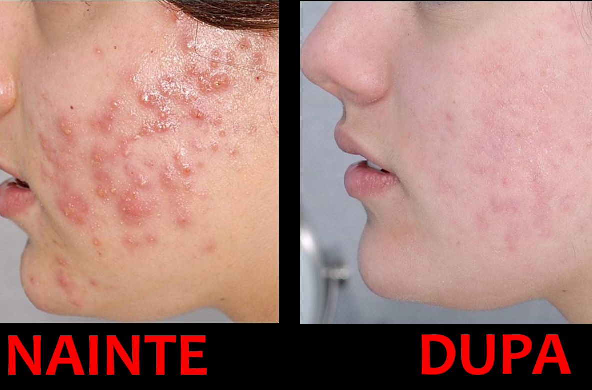 Scapă de coșuri cu acest tratament anti-acnee