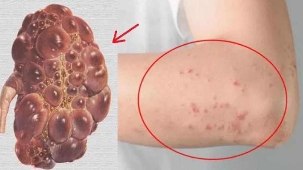 Semne ascunse care indica probleme cu ficatul