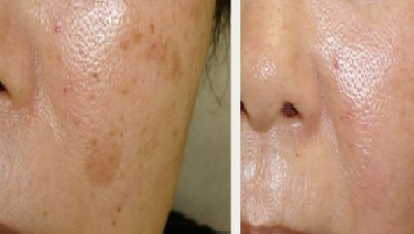 Şi-a dat pe faţă cu suc de lămâie în fiecare zi! Uite ce lucru uimitor i s-a întâmplat!