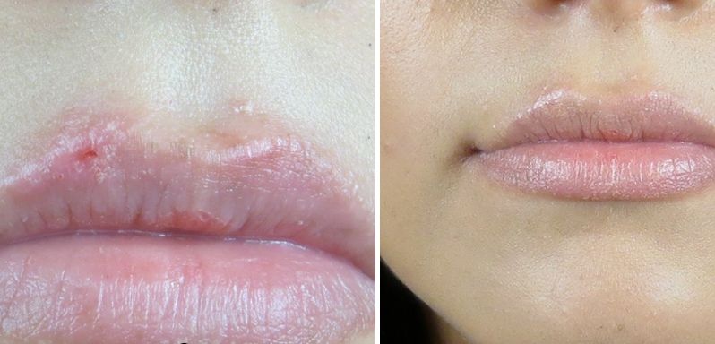 Cum scapi de buzele crăpate. Ce trebuie să faci ca să nu ţi se mai întâmple asta