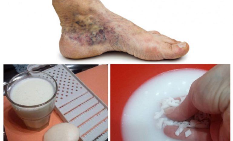 Tratament pentru vene vericoase și tromboză cu două ingrediente