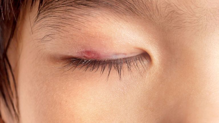 Cum scapi rapid de urcior cu remedii naturiste