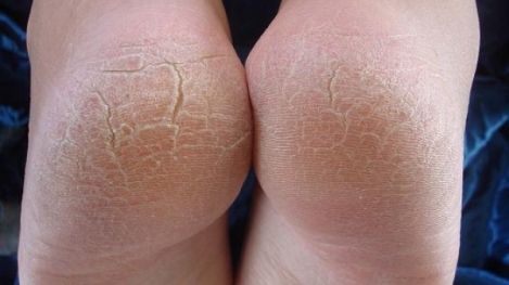 Cum să scapi definitiv de călcâiele crăpate