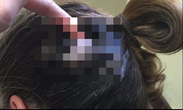 A văzut că i se mișcă ceva sub păr. L-a atins și s-a îngrozit! Era de mărimea unui ou