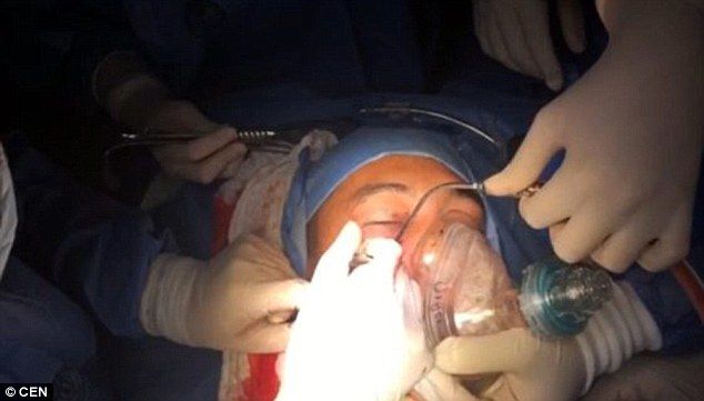 A venit la spital cu o grenadă amorsată în cap. Medicii, în stare de șoc. Ce au văzut la radiografie