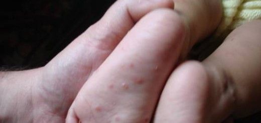 Atenţie, părinţi! Epidemie în sudul ţării, la preşcolari: care sunt simptomele bolii