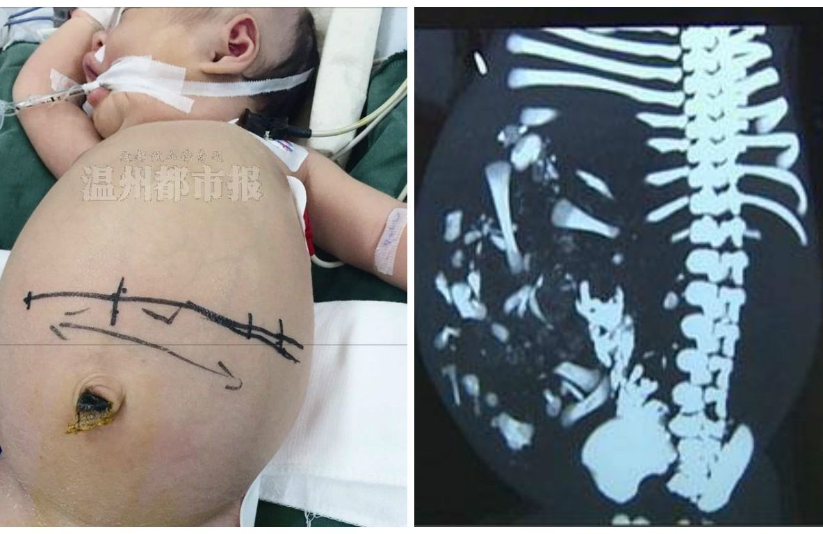 S-a născut cu bine, dar avea abdomenul umflat. ȘOCANT: ce au găsit medicii în burta bebelușului