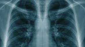 Uleiul care ucide celulele cancerului de plămâni. Are un puternic efect antiseptic