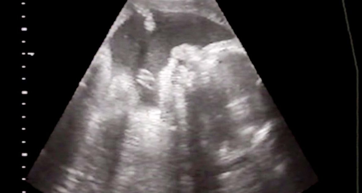 Însărcinată în 20 de săptămâni, femeia și soțul ei căutau coșciug pentru bebeluș. Motivul e teribil