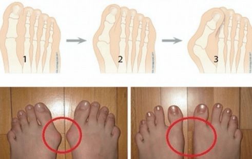 De ce apar monturile și cum scăpăm de ele FĂRĂ operaţie