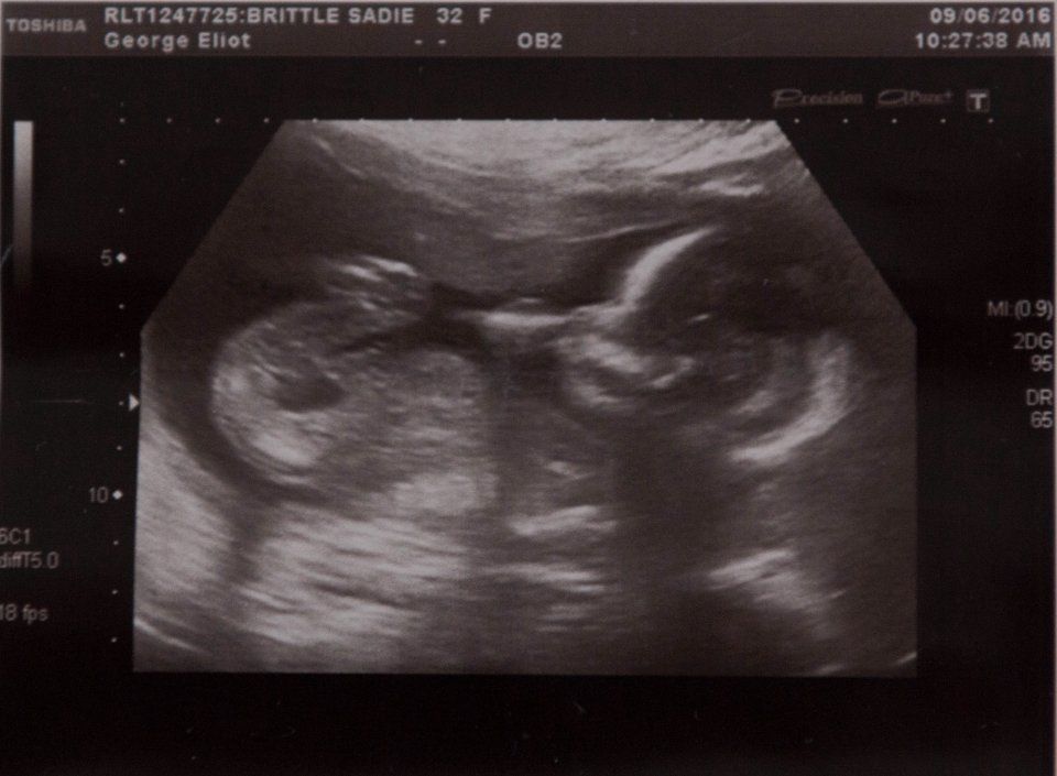 Pierduse sarcina, erau devastați.3 luni mai târziu,medicul a anunțat-o că... Era prea mult pentru ea