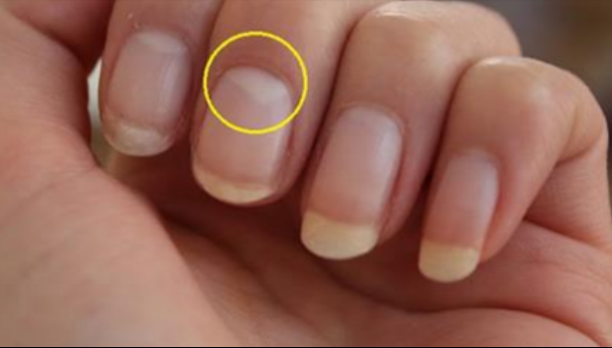 Ce înseamnă când lipsește semiluna de la baza unghiei. E grav! Mergi repede la medic