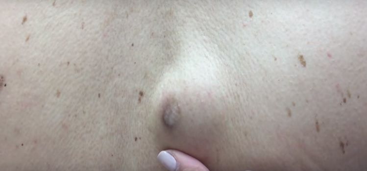 Avea un chist pe spate. S-a operat. Doctorul şi asistentele, aproape de leşin când au văzut ce iese