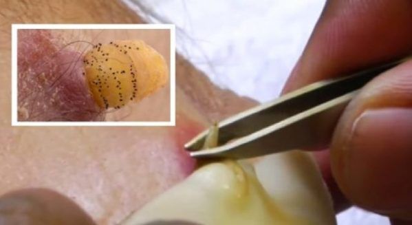 Credea că are un simplu coş pe spate. A mers la doctor. HORROR. Ce au putut scoate din pielea lui