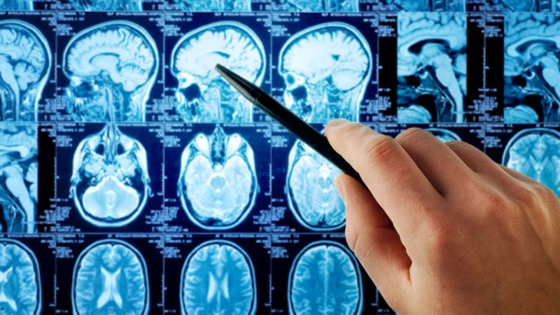 Un bărbat trăieşte fără 90% din creier şi merge la job în continuare. Medicii sunt şocaţi