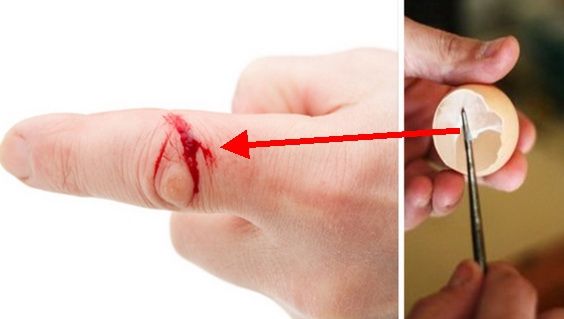 S-a tăiat la mână și a pus pielița de la ou pe rană. Ce s-a întâmplat după