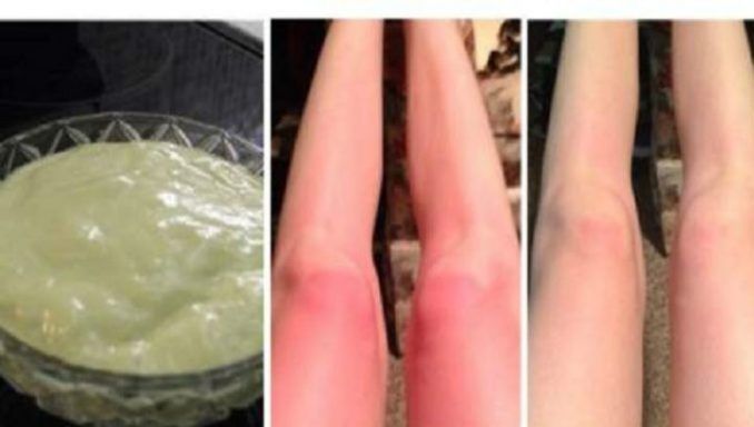 Remediul ideal pentru arsurile solare