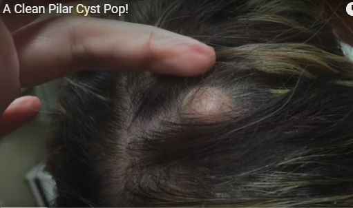 Avea un cucui în cap care nu se mai desumfla. A luat bisturiul și l-a tăiat. Medicul a încremenit!