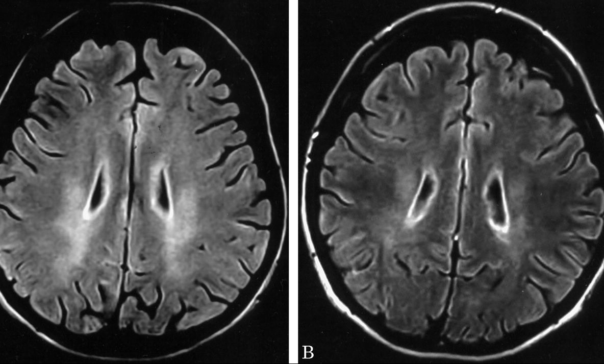 ŞOC în lumea sportivă: un celebru antrenor, diagnosticat cu o maladie neurologică. Ar putea paraliza