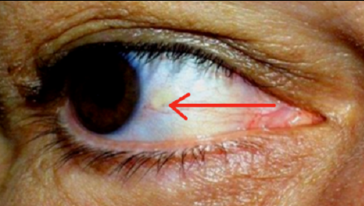 Ai aşa ceva la ochi? Iată ce probleme GRAVE de sănătate indică această pată galbenă