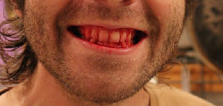 Cum arată omul care mănâncă doar carne crudă de 7 ani încoace. FOTO ȘOCANT