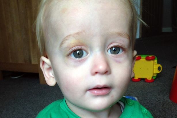 A observat că fiul ei are o vânătaie. A crezut că s-a lovit. ȘOC! Ce a descoperit era foarte grav