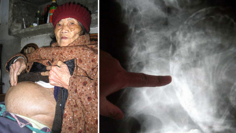 Femeia care a ULUIT medicina. A ţinut un făt în pântece timp de 60 de ani 