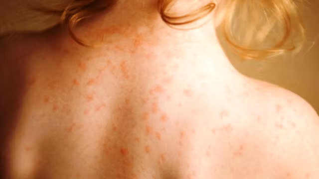 FRESH REFRESH. Nu neglijați dermatita atopică, boala care îi afectează și pe copii, și pe adulți