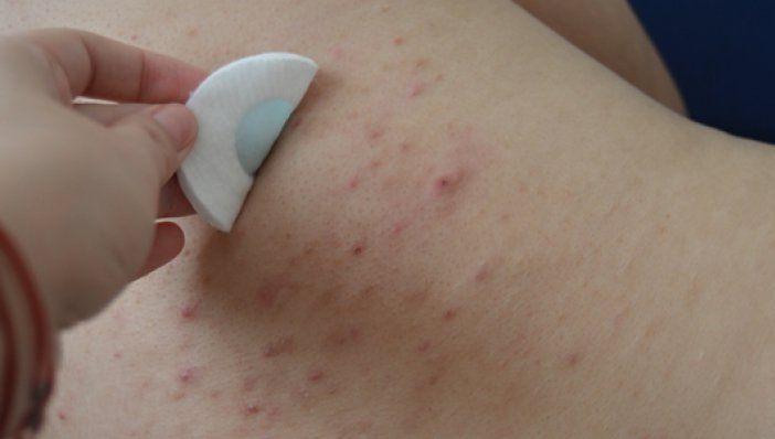 Cum scapi de coșurile de pe spate. Cele mai ieftine ingrediente. Le ai în casă