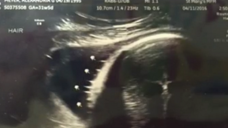 Detaliul din ecografie le-a scăpat initial. O prietena l-a observat mai tarziu: "E un miracol!" 