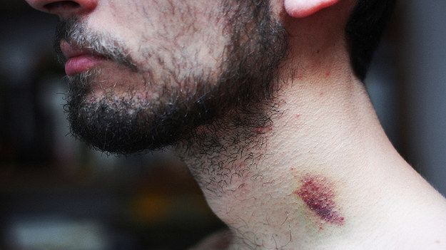 Un tânăr a murit după ce iubita l-a sărutat pătimaş pe gât! Ce au descoperit medicii