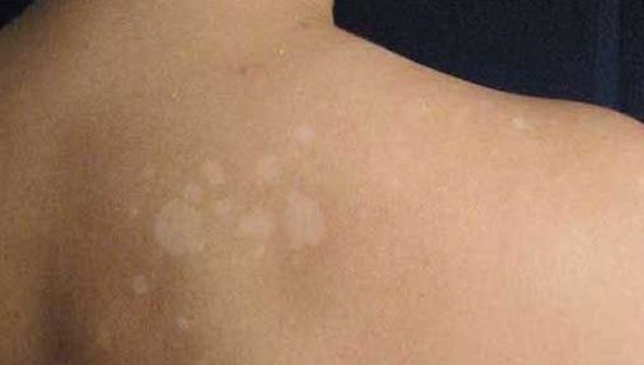 Mare atenţie! A mers la piscină şi i-au apărut aceste pete pe corp. Ce i-au zis medicii