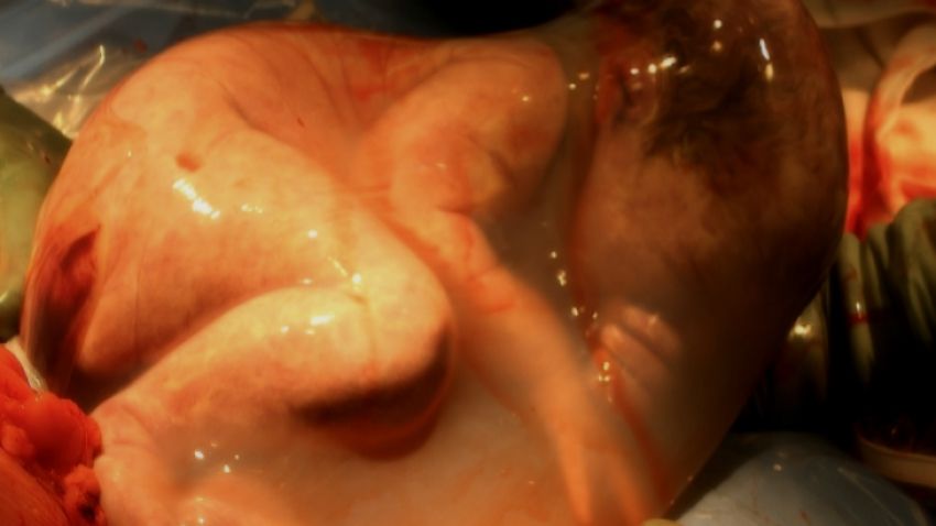 Un bebeluş respiră în sacul amniotic intact, după o naştere prin cezariană. Imagini impresionante!