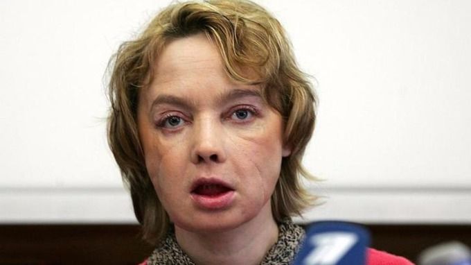 Prima femeie care și-a făcut transplant de față a murit  