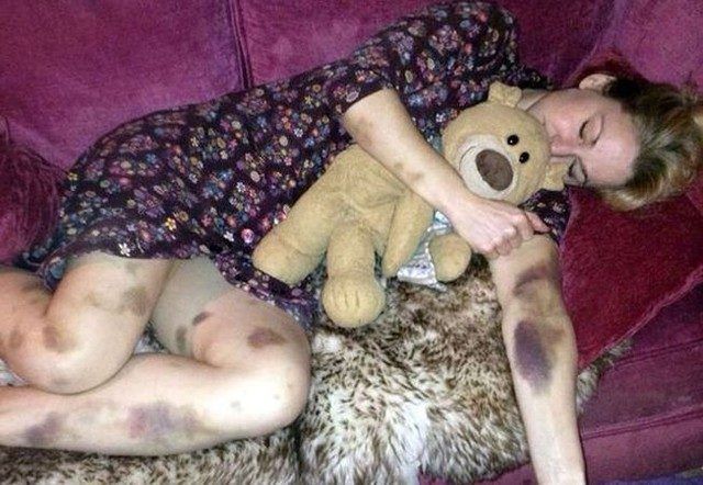 A mers la culcare sănătoasă şi s-a trezit cu întreg corpul acoperit de vânătăi. Diagnosticul e CRUNT