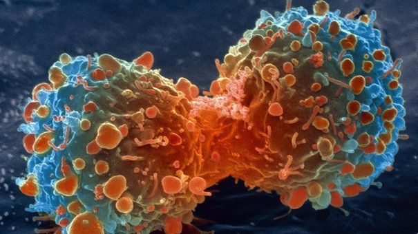 Semnele surprinzatoare care îţi spun că deja ai celule canceroase în corp