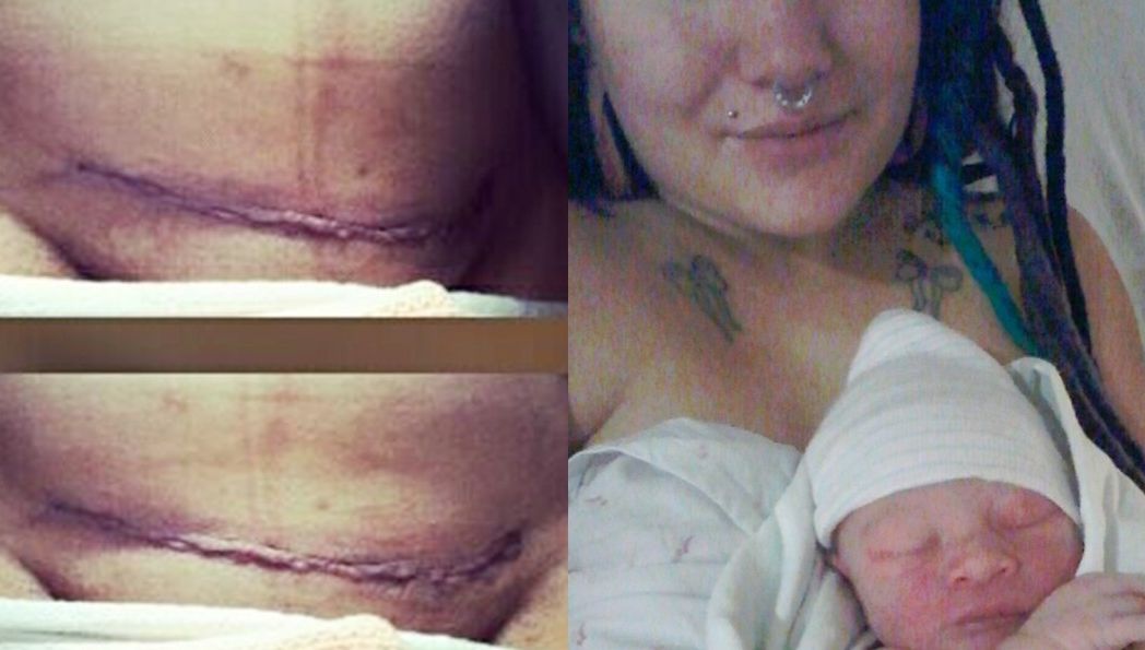 Mesajul ŞOCANT al unei mămici care a născut prin cezariană: "Voi numiți asta noroc?"