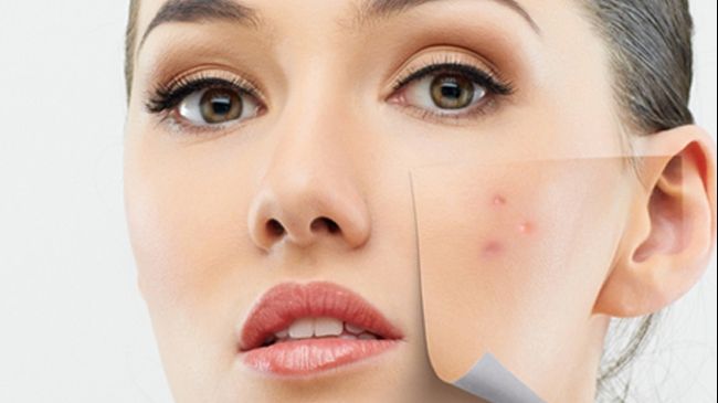 Leacul neştiut pentru acnee şi coşuri