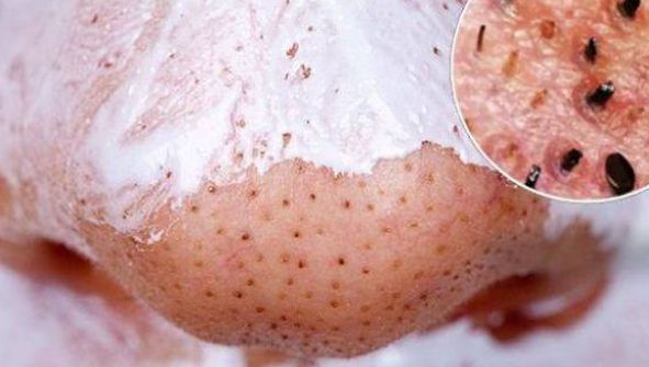 Cum scapi rapid de punctele negre. Pentru totdeauna!