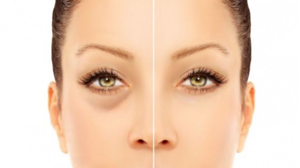 Combină două ingrediente şi cercurile negre de sub ochi dispar!