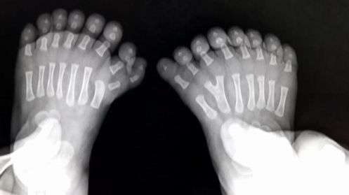 Un bebeluş s-a născut cu 31 de degete! Terifiaţi, medicii au luat o DECIZIE înfiorătoare