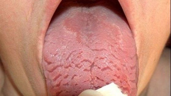 Dacă limba ta arată aşa, iată ce afecţiune gravă ai putea să ai