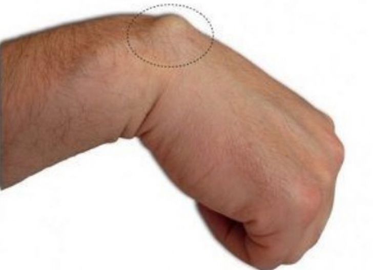 Cel mai rapid tratament naturist pentru lipoame